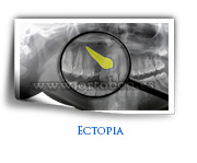 Ectopia